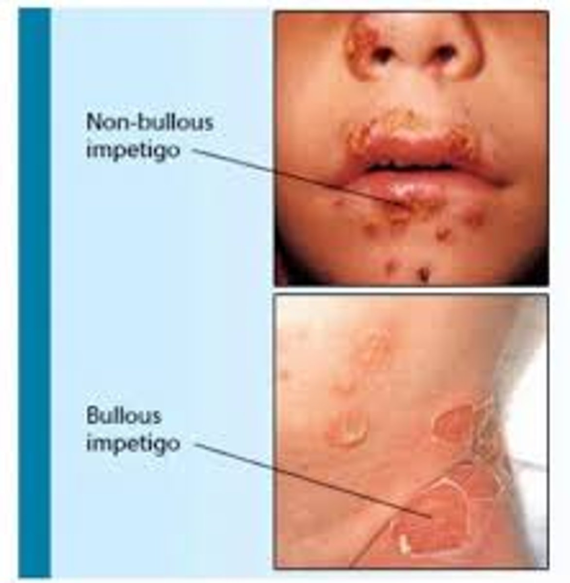 <p>Golden crust lesions in both</p><p>Non - bullous impetigo</p><p>- Starts as small red sores around the nose and mouth</p><p>- Quickly develops into blisters and bursts</p><p>- Can be itchy but otherwise asymptomatic; not painful</p><p>Bullous impetigo</p><p>- Common in neonates</p><p>- Starts as fluid filled blisters on trunk or arms/legs</p><p>- Quickly spreads before bursting</p><p>- Can be painful and itchy</p><p>- Fever and swollen lymph glands is more common</p>