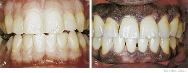 <p><span>Consists of healthy supporting tissues that include the alveolar bone, cementum, periodontal ligaments, and the gingiva. Healthy gingiva is usually pink or coral pink but may have a brown pigment in individuals with darker skin.</span></p>