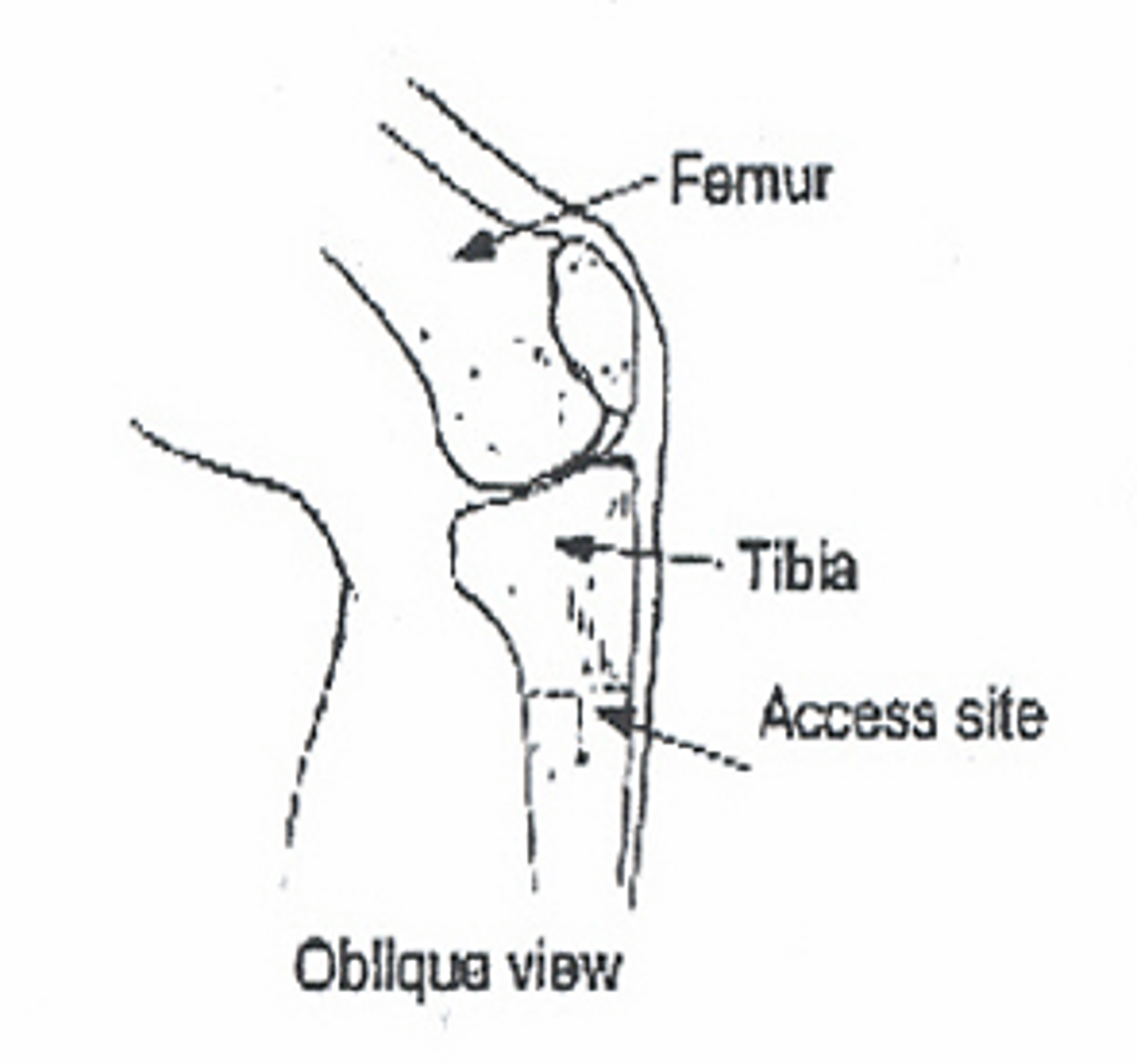 <p>-Sandbag under knee for support</p><p>-Locate area of insertion</p><p>-Cleanse skin</p>