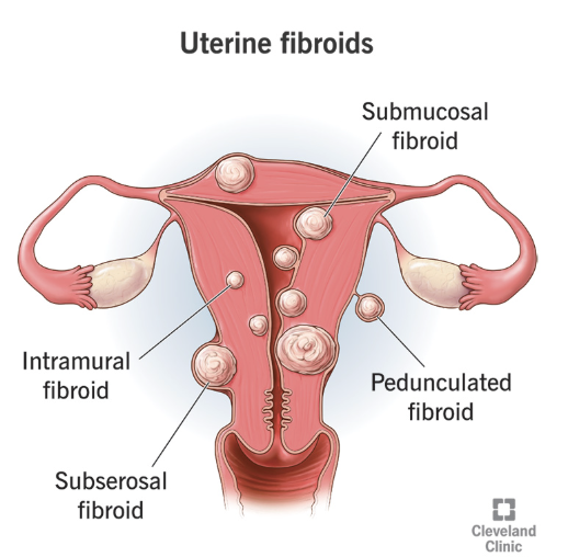 <p>Intramural (most common), submucosal, subserosal, parasitic </p>