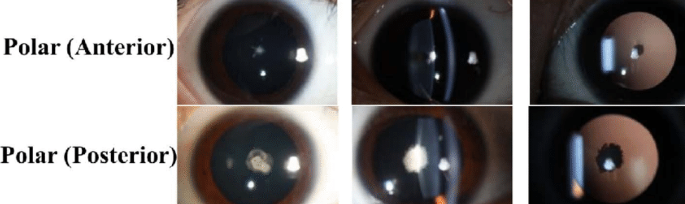 <ul><li><p><span><strong><span>Anterior polar</span></strong><span>: small white lenticular opacity of the anterior capsule</span></span></p><ul><li><p><span><span>May have an associated </span><em><span>underlying cortical opacity</span></em><span> that is slightly </span><em><span>larger</span></em><span> than the capsular opacity</span></span></p></li><li><p><span><span>can project into anterior chamber</span></span></p></li><li><p><span><span>most don’t affect vision</span></span></p><ul><li><p>pts do tend to have assoc. hyperopic anisometropia = amblyopia risk</p></li></ul></li></ul></li><li><p><strong>Posterior polar</strong>: opacity of the posterior capsule</p><ul><li><p>arise from the end of the <em>hyaloid artery remnant</em></p></li><li><p>bilateral</p></li><li><p>glare and halos</p></li></ul></li></ul><p></p>