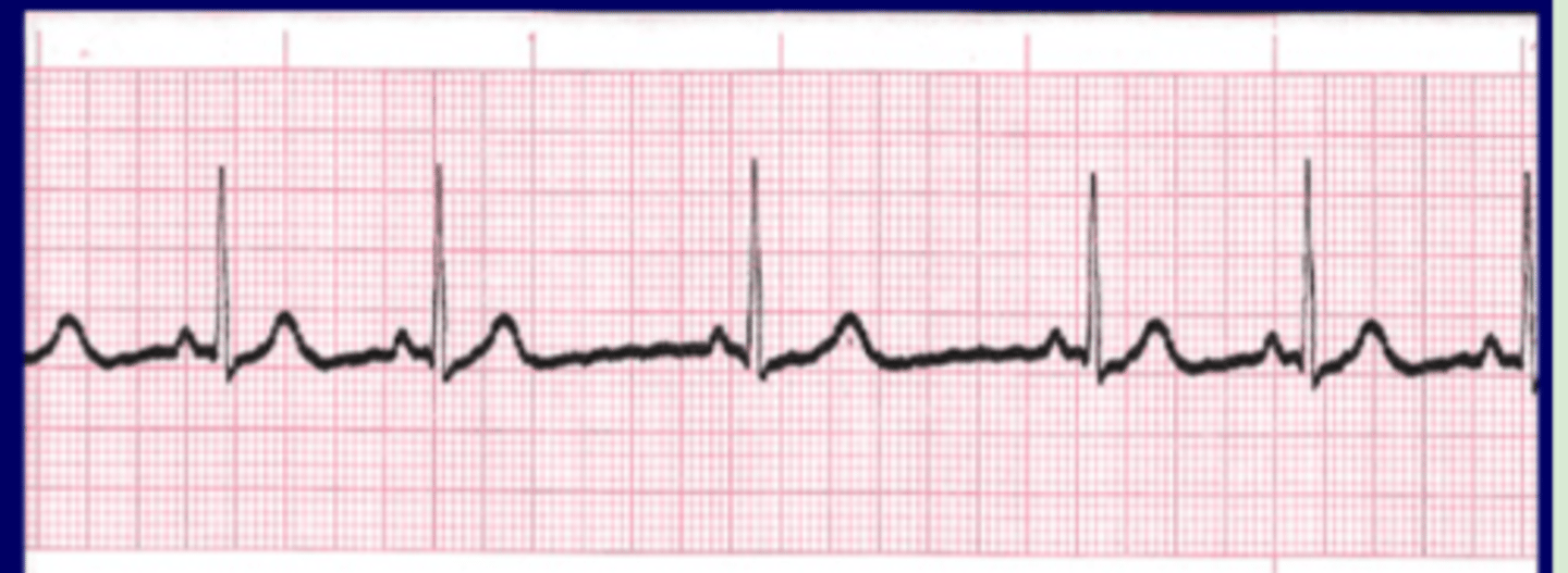 <p>Originate: SA node</p><p>QRS complex: narrow</p><p>P wave: same</p><p>Heart rate: 60-100 bpm</p><p>R-R intervals: irregular</p>