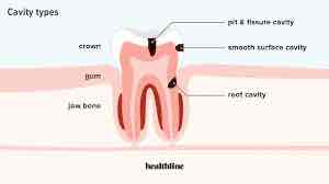 <p>Cavity </p>