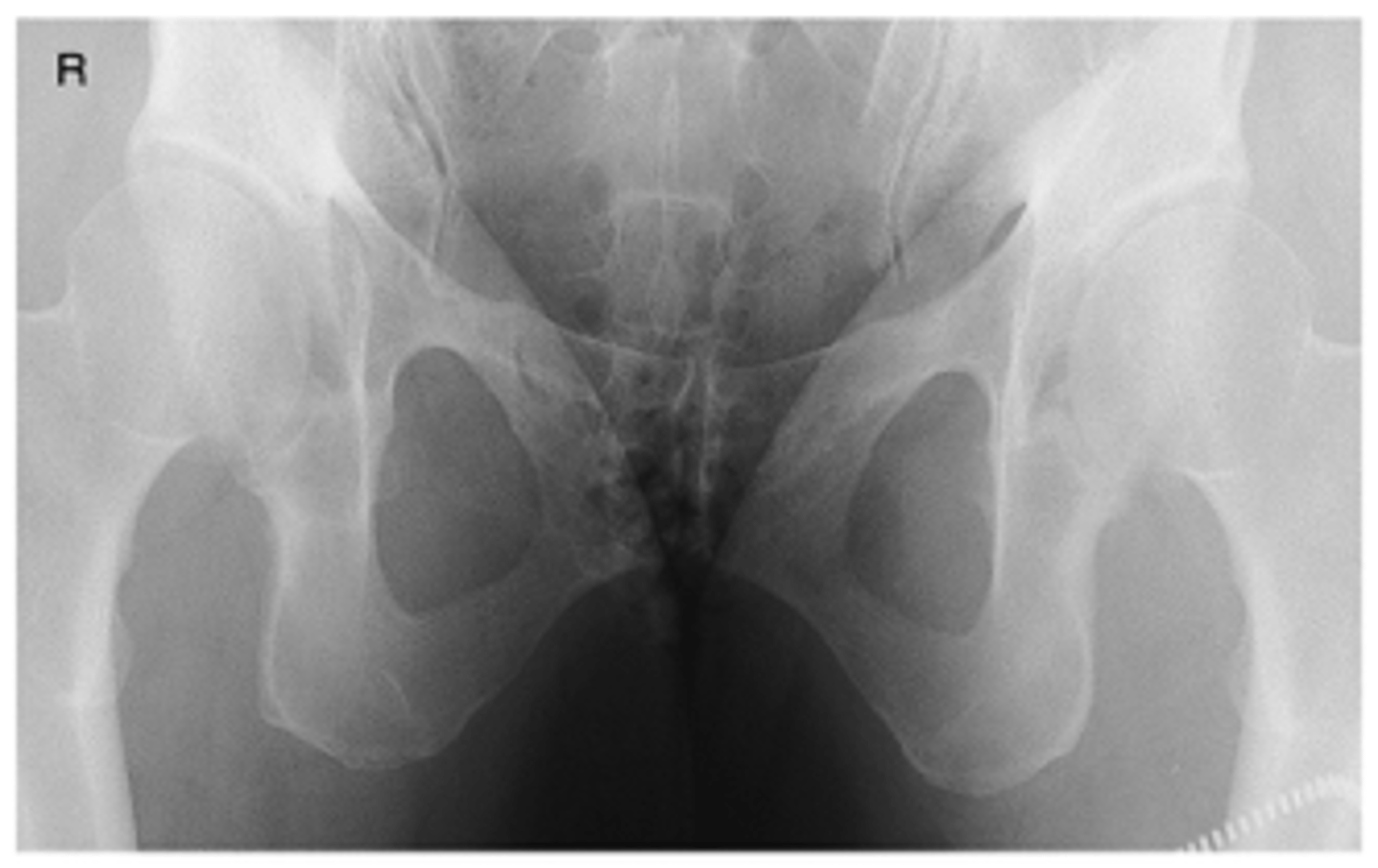 <p>- CR 20° to 35° cephalad (males), 30° to 45° cephalad (females)</p><p>- CR centered to 1-2 inches (3-5 cm) distal to symphysis pubis</p><p>- Elongated and magnified pubic and ischial bones</p><p>- No rotation of pelvis</p><p>- Pubic and ischial bones centered to collimation field</p><p>- Optimal exposure factors</p>