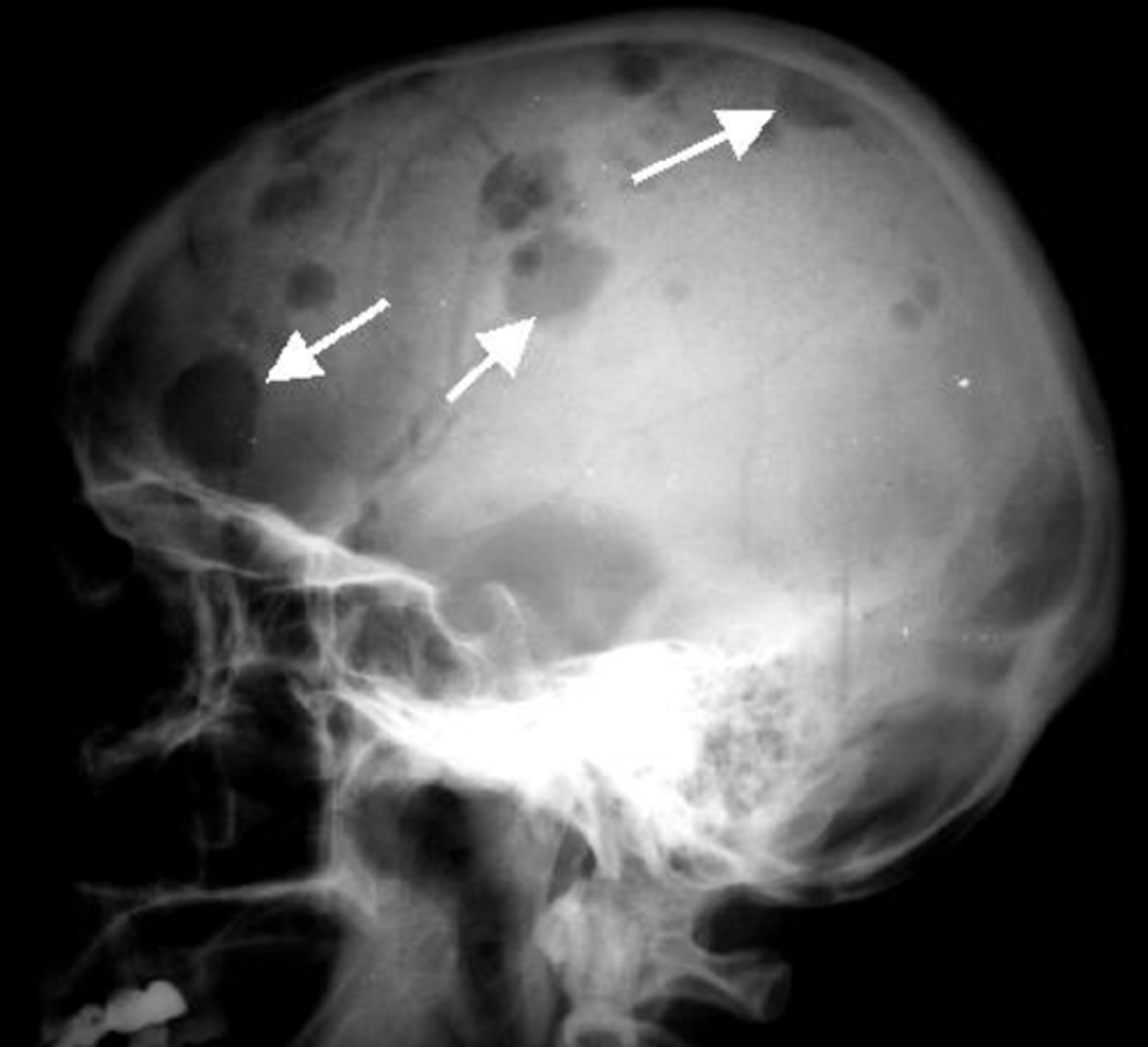 <p>Bone lesions</p>