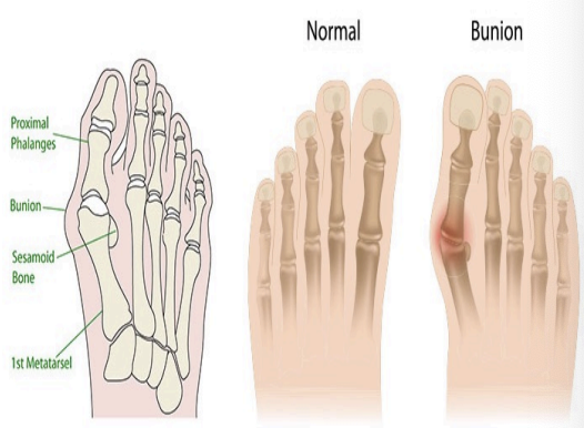 <p>Bunion (Hallux vulgus)</p>