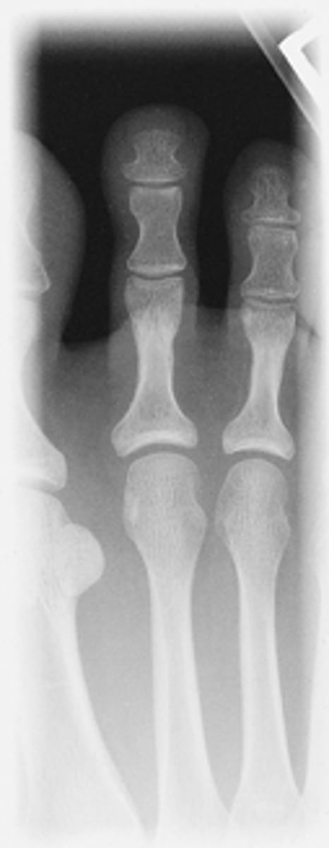 <p>- 15° wedge, CR perpendicular to IR</p><p>- Digits and minimum of distal ½ of metatarsal demonstrated</p><p>- No overlap of soft tissues</p><p>- IP and MTP joints appear open</p><p>- Optimal exposure factors</p>