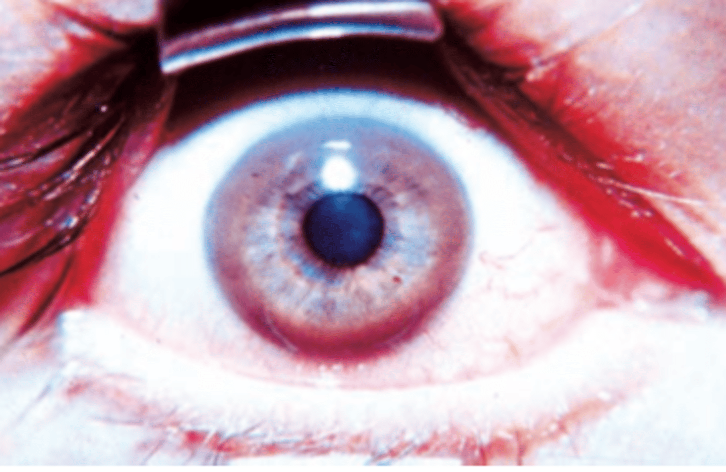 <p>A 15-year-old boy complains of a 2-month history of fatigue, abdominal pain, and yellow eyes and skin. Physical examination shows tremor of his hands, lack of coordination, and mild jaundice. The results of an ophthalmic examination are shown in the image. This patient most likely has an inborn error of metabolism associated with tissue overload of which of the following elements?</p><p>(A) Copper</p><p>(B) Iron</p><p>(C) Lead</p><p>(D) Magnesium</p><p>(E) Mercury</p>