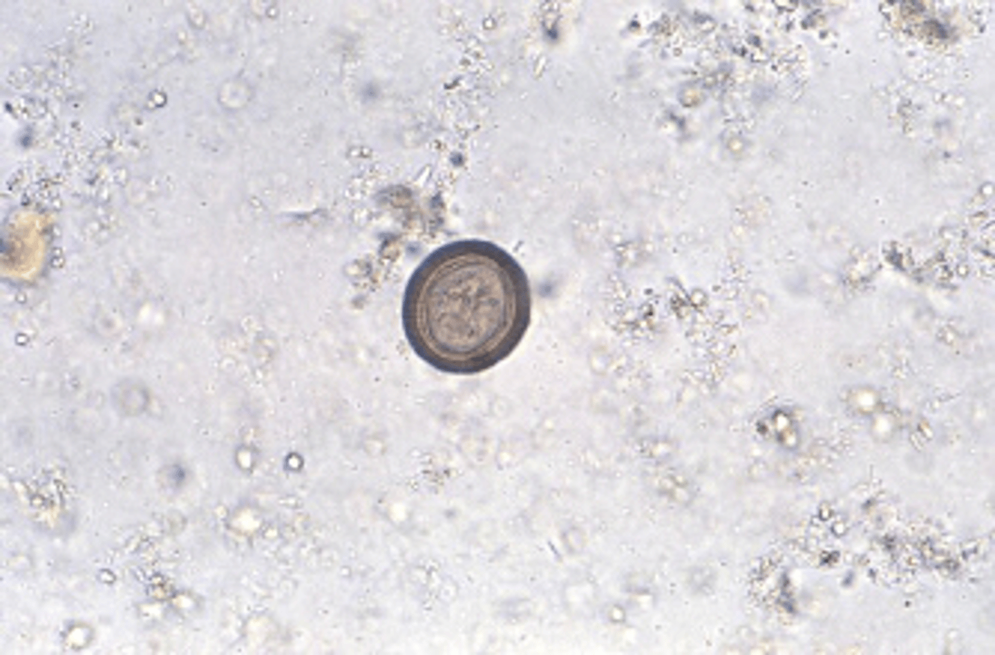 <p>b.Taenia spp.</p><p>Laboratory diagnosis of Taenia spp. infection can be made by finding the egg, scolex, or proglottid in the feces. The egg is yellow-brown and surrounded by a thick wall with radial striations; it measures 30 to 43 μm. The egg is embryonated with a six-hook oncosphere when passed in the feces. Eggs of this species are indistinguishable and must be reported as “Taenia spp.” eggs. </p>