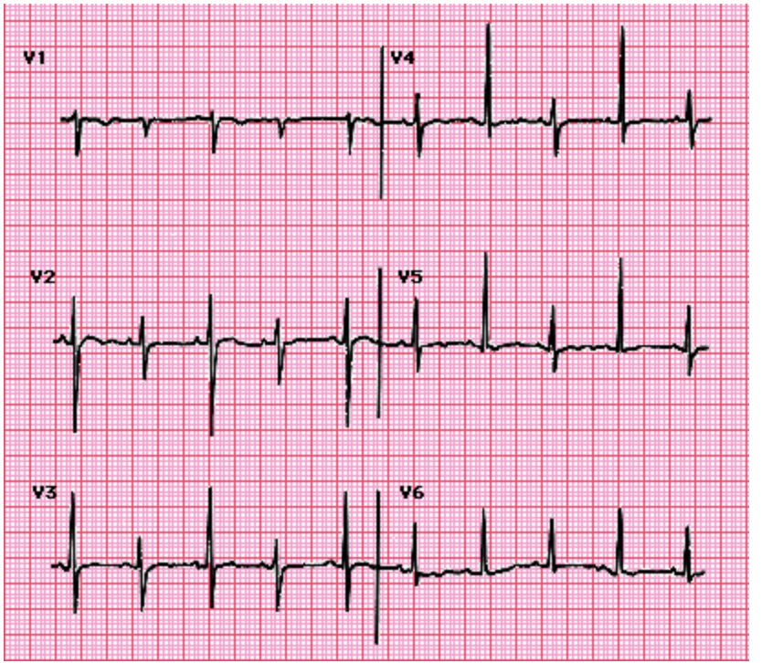 <p>Patients is brought to the ER for chest pain and SOB. On a physical exam you note that the patient is clammy to the touch and has cool extremities. You also see elevated JVP and muffled heart sounds. Vitals are stable with the exception of tachypnea, tachycardia, and severe hypotension. After you throw an A line in, you see a 10 mmHg drop of the SBP during inspiration. You are handed this EKG, what test do you want?</p>