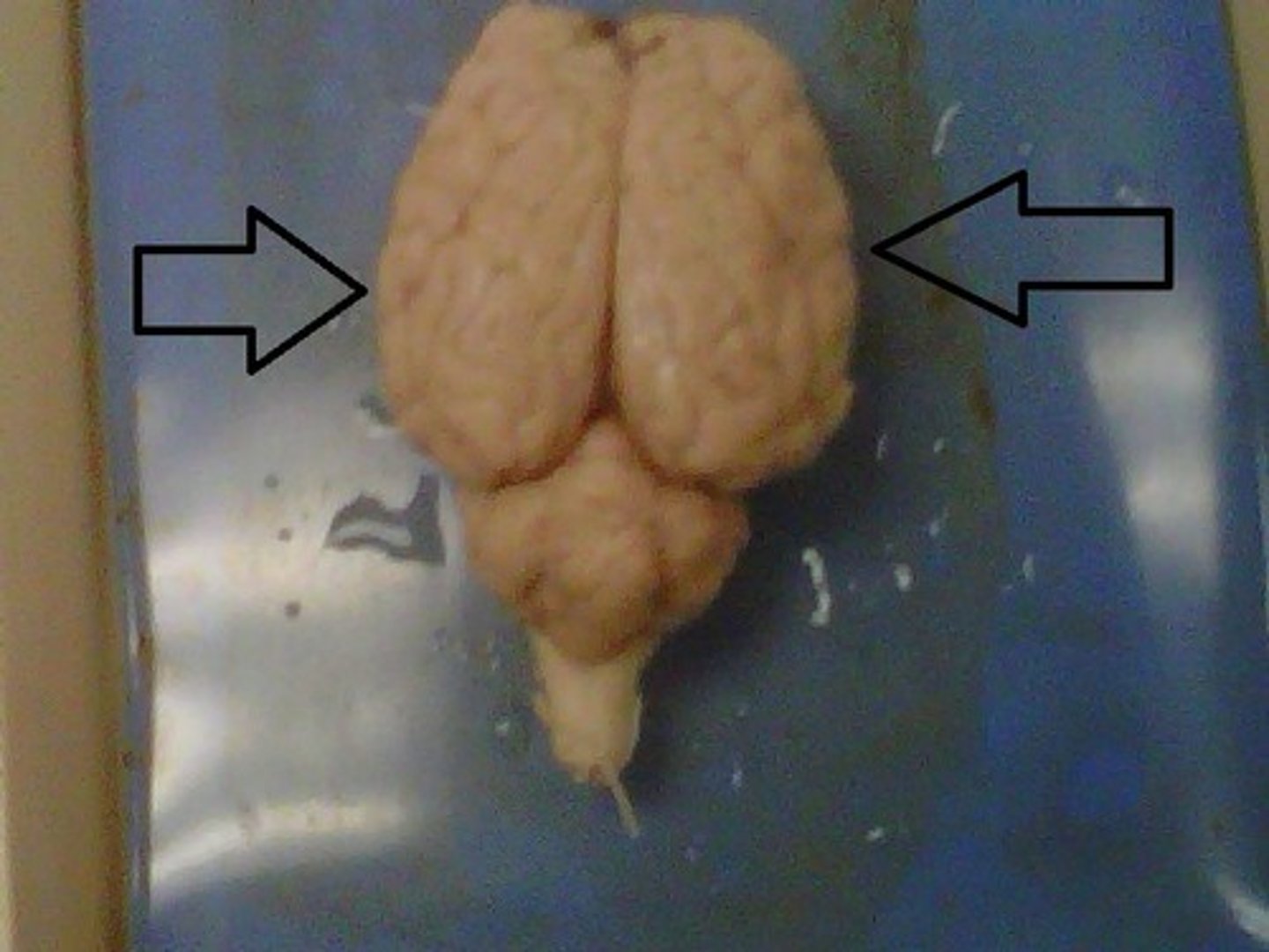 <p>Left and right halves of the cerebrum, separated by the longitudinal fissure.</p>