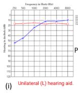 <p>What patient is this? What kind of hearing loss is this? </p>