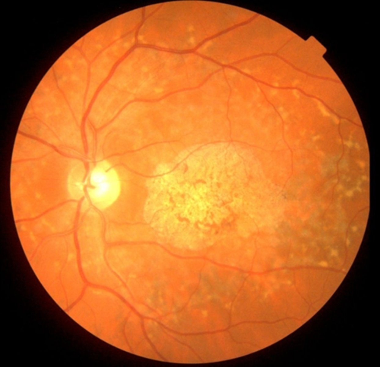<p>bilateral central VA loss</p><p>photophobia</p><p>color vision anomalies</p><p>central scotomas</p><p>slow dark adaptation</p>
