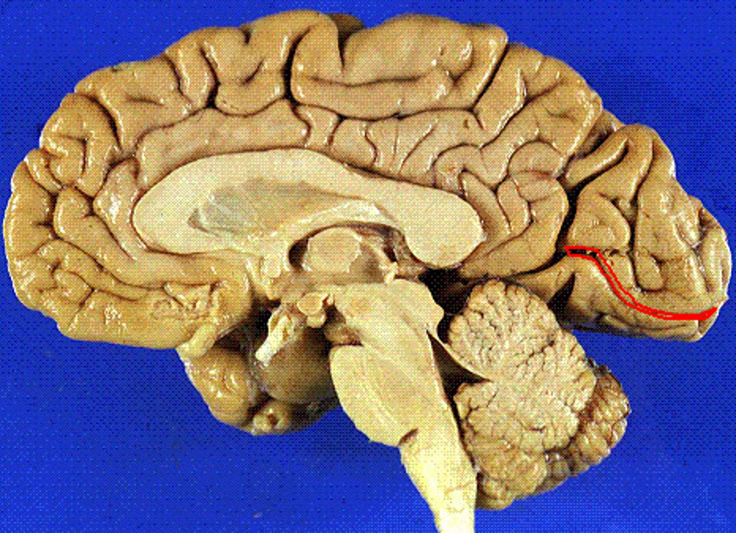 <p>located between cuneus and lingual gyrus</p>