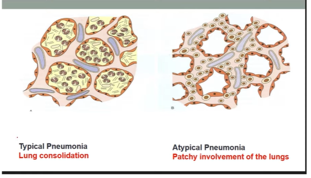 <p><strong>Typical:</strong></p><ul><li><p>death in uncs</p></li><li><p>Pneumococcal pneumoniae </p></li><li><p><strong>Marked inflammation</strong> of lungs</p></li><li><p><strong>Exudate (fluid + debris)</strong> fills alveoli → <strong>lung consolidation (clear 99)</strong></p></li><li><p><strong>s/s:</strong></p><ul><li><p>Purulent (thick/yellow-green) sputum</p></li><li><p>Severe fever, chills, malaise, pleuritic pain</p></li><li><p>Egophony → aaa instead of eee</p></li></ul></li><li><p><strong>Seen clearly on chest X-ray</strong></p></li></ul><p><strong>Atypical (Walking):</strong></p><ul><li><p>from <strong>viruses or Mycoplasma pneumoniae</strong></p></li><li><p><strong>Patchy</strong> lung involvement → mainly affects <strong>alveolar septa & interstitium</strong></p></li><li><p><strong>No alveolar exudate → No lung consolidation</strong></p></li><li><p><strong>Symptoms:</strong></p><ul><li><p>Mild/moderate sputum</p></li><li><p>Mild fever, less severe illness (“walking”)</p></li></ul></li><li><p><strong>Moderate increase</strong> in white blood cell count</p></li></ul><p></p>
