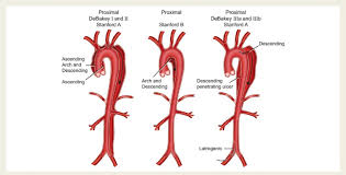 <p><strong>Aortic Aneurysm Dissection: General Info</strong></p><p>-Circumferential or transverse ____ of the intima of aorta</p><p>-Often occurs along right _______ wall</p><p>-Initiating event could be primary intimal tear or medial ___________, both of which create a false _____ for blood to go into</p><p>-Stanford Type A = __________ aorta affected</p><p>-Stanford Type B = ___________ or transverse aorta affected </p>