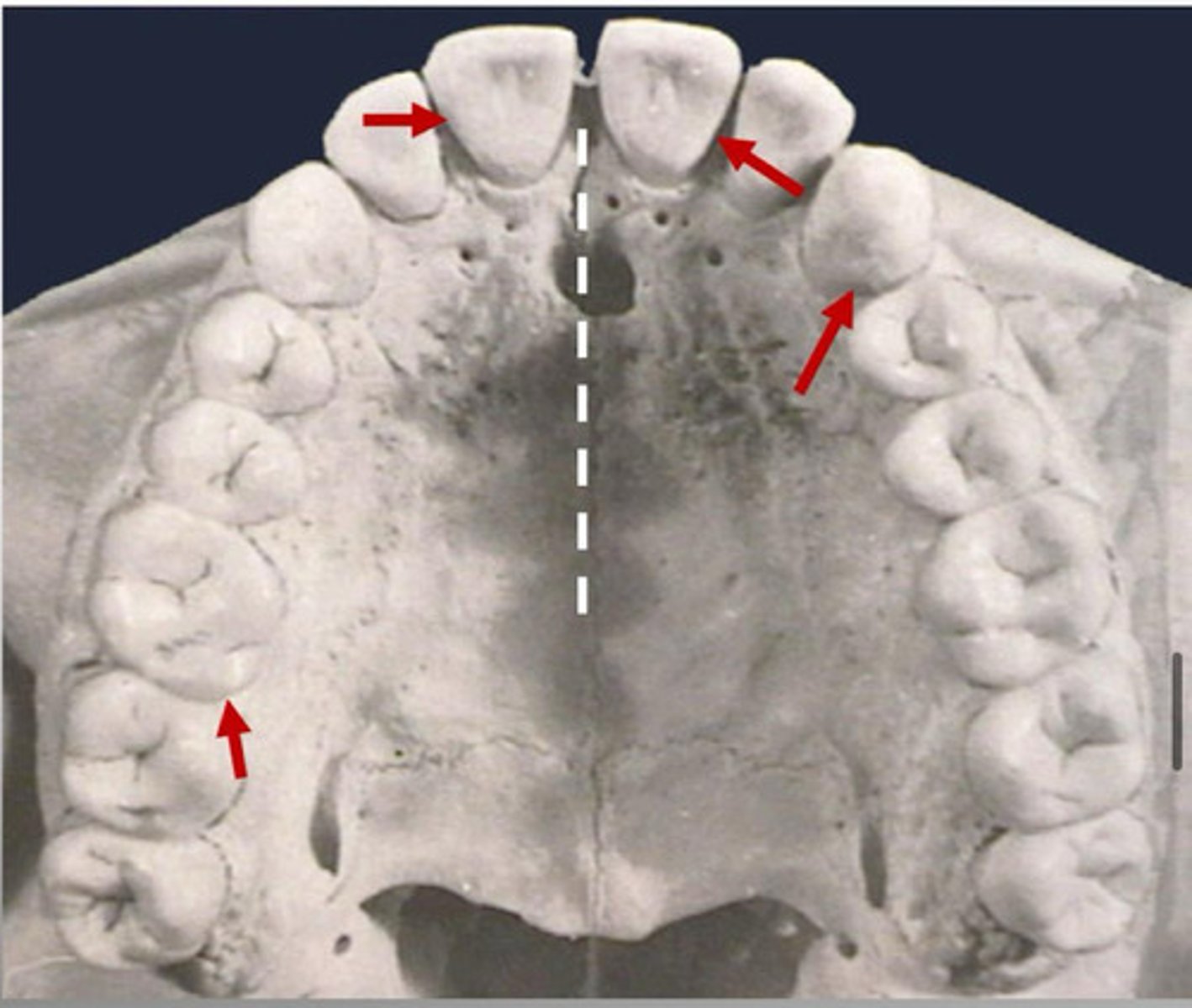<p>Is the surface of the tooth farthest to the midline of dental arch</p>