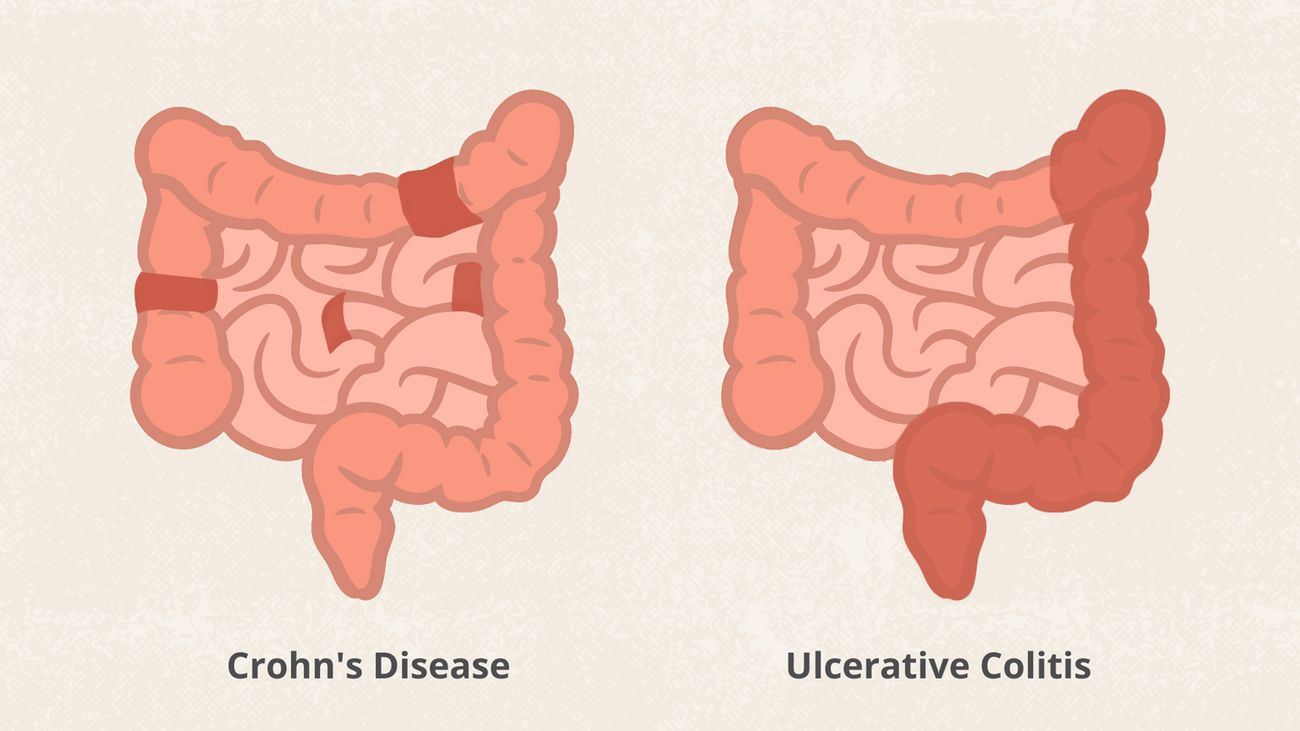 <p>Crohn’s- skip lesions</p><p>UC- continuous</p>