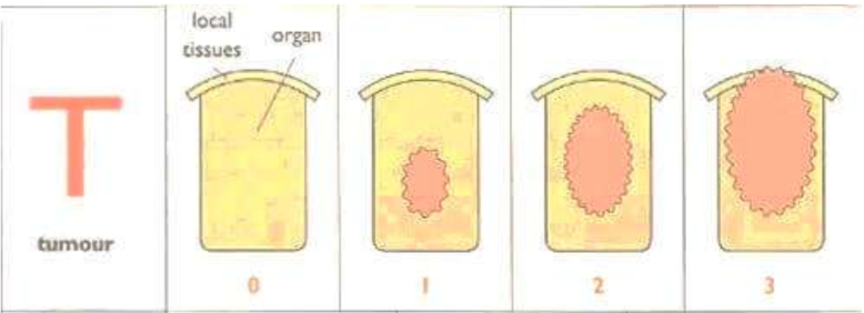 <p>T means tumor and it describes the stages of the size of the tumor in an organ.</p><ul><li><p>As you can see in the picture, stage 3 indicates the tumor being large enough to push through local tissue</p></li></ul><p></p>