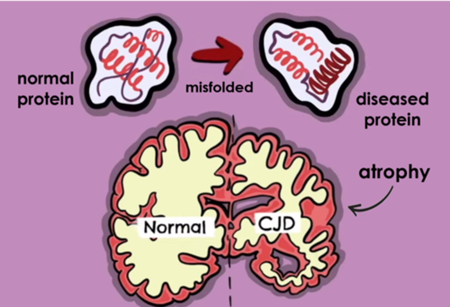 <p>an infectious, abnormal protein that contains no nucleic acid, does not trigger an immune response, & cannot be destroyed by extreme heat or cold; it causes fatal, degenerative diseases like CJD (Creutzfeldt-Jakob Disease)</p>