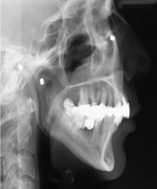<p>outline cervical spine maturation</p>
