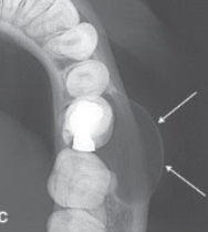 <p>x-rays are more attenuated at the curves of a bony structure than those traveling at right angles to surface </p>
