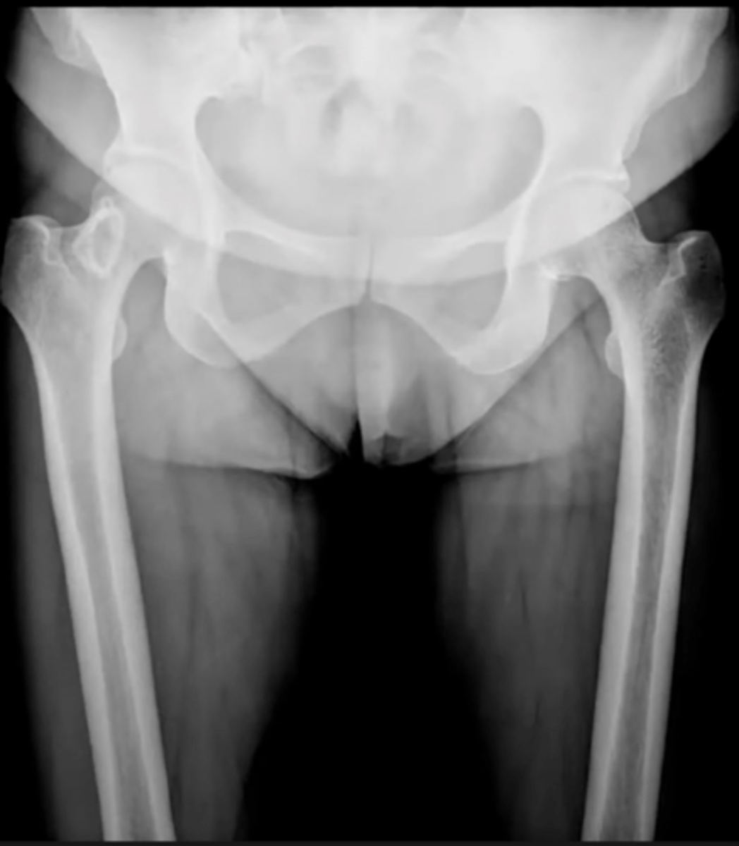 <p>What is this?</p><p>Ex. Pt is asymptomatic, lesion found incidentally</p>