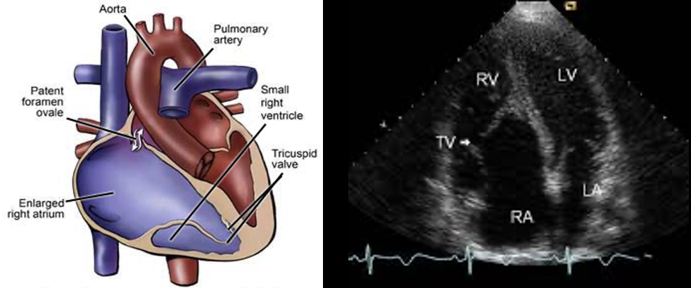 <p>_________<span>in which a malformed tricuspid valve sits lower than normal in the right ventricle, causing blood to flow back into the right atrium (TR).</span></p>