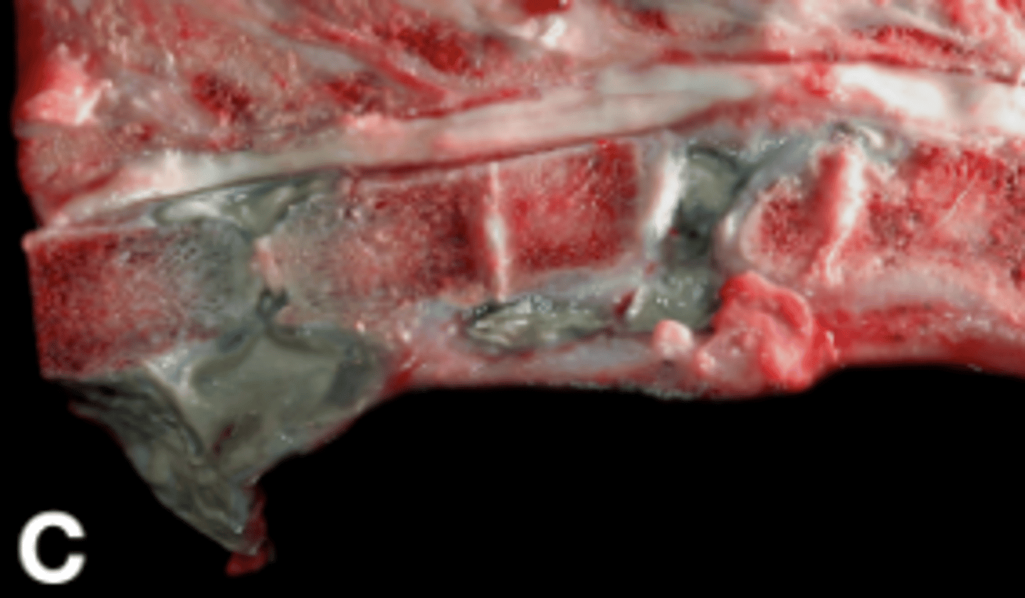 <p>- Malacia is common</p><p>- Discospondylitis (C) (inflammation of the intervertebral discs and adjacent vertebral bodies) is often due to hematogenous bacterial infection</p>
