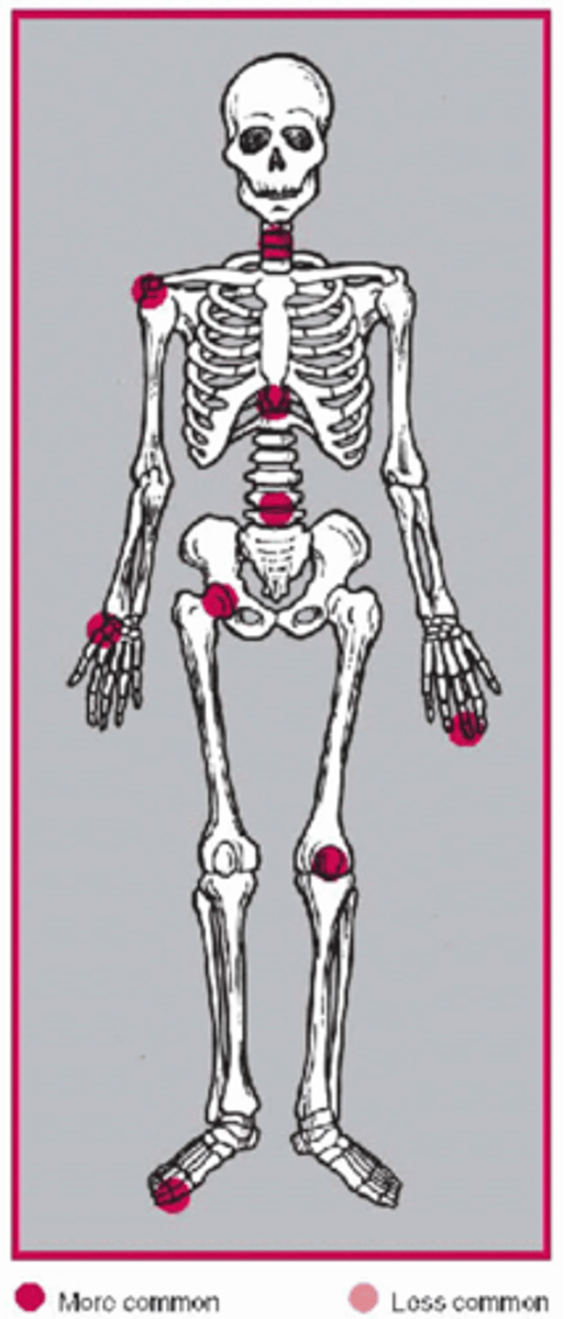<p>State the common locations affected by degenerative joint disease</p>