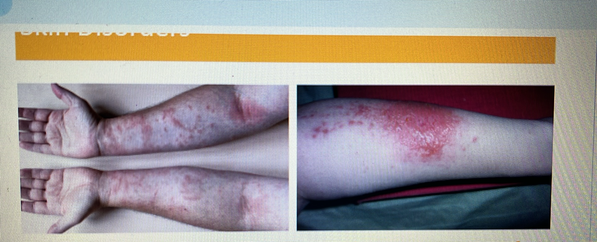 <p><span style="font-family: Calibri, sans-serif"><strong>Contact dermatitis and Poison Ivy Rash</strong></span></p>