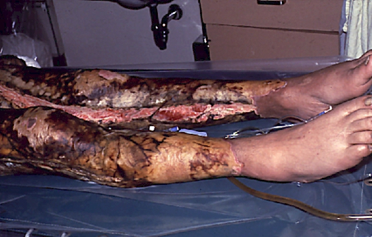<p>3rd degree burn-Causes</p>