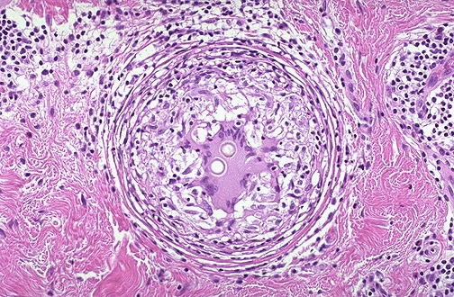<ol><li><p>Cause of granulomatous inflammation</p></li><li><p>Typical morphology of granuloma</p></li><li><p><span>the fungus known as </span><em>Coccidioides immitis</em><span>, giant cell in the center, presents&nbsp;</span></p></li></ol><p></p>