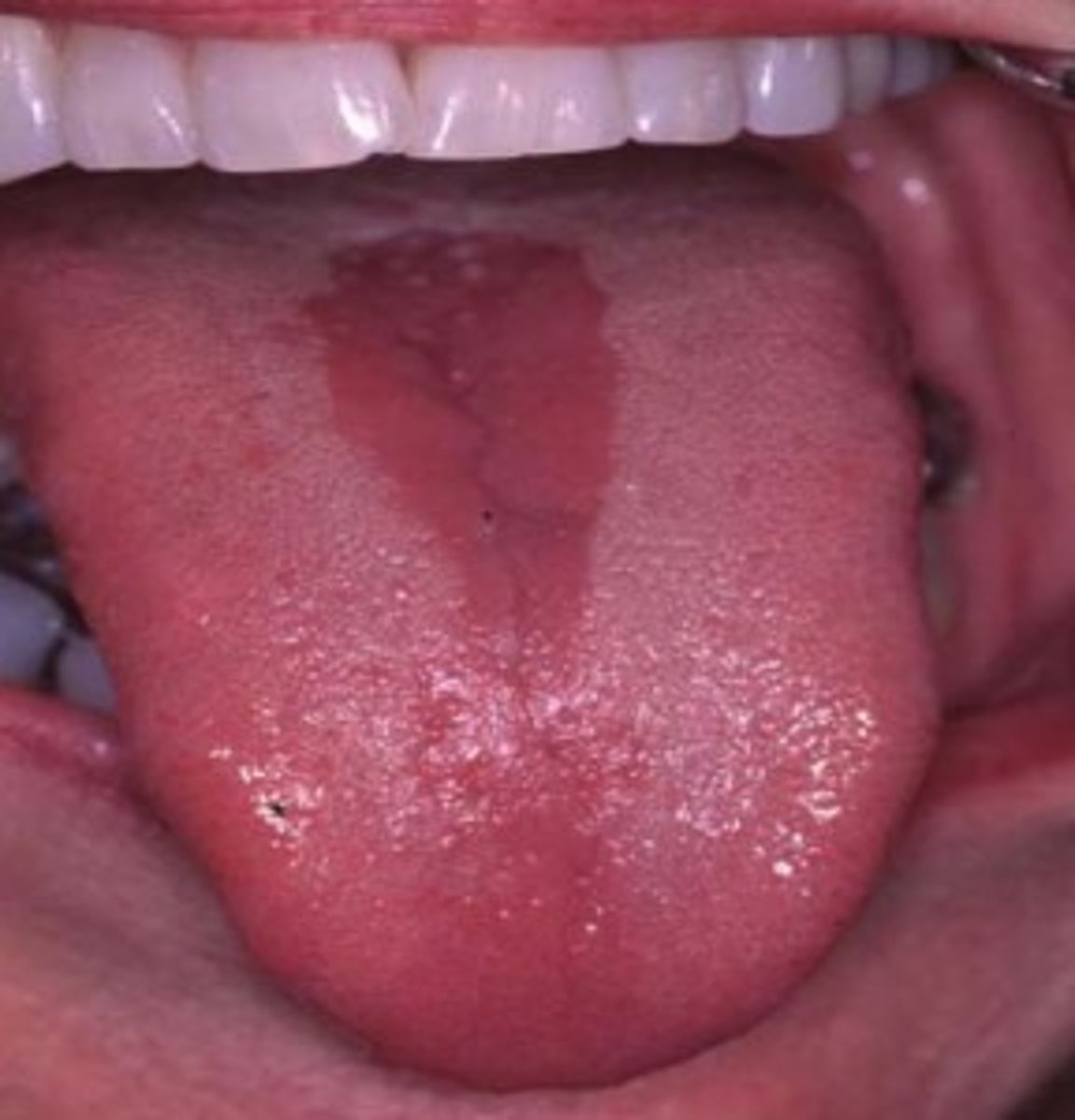 <p>AKA Central Papillary Atrophy; well-defined red patch at midline of posterior dorsal tongue</p><p>• asymptomatic</p><p>• candidiasis</p>