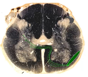 <p>spinal projection neurons→proper sensory nucleus (lamina 5)→axons cross at ventral white commissure→ascend in the anterolateral system (<strong>intermingled with spinothalamic tract</strong>)</p>