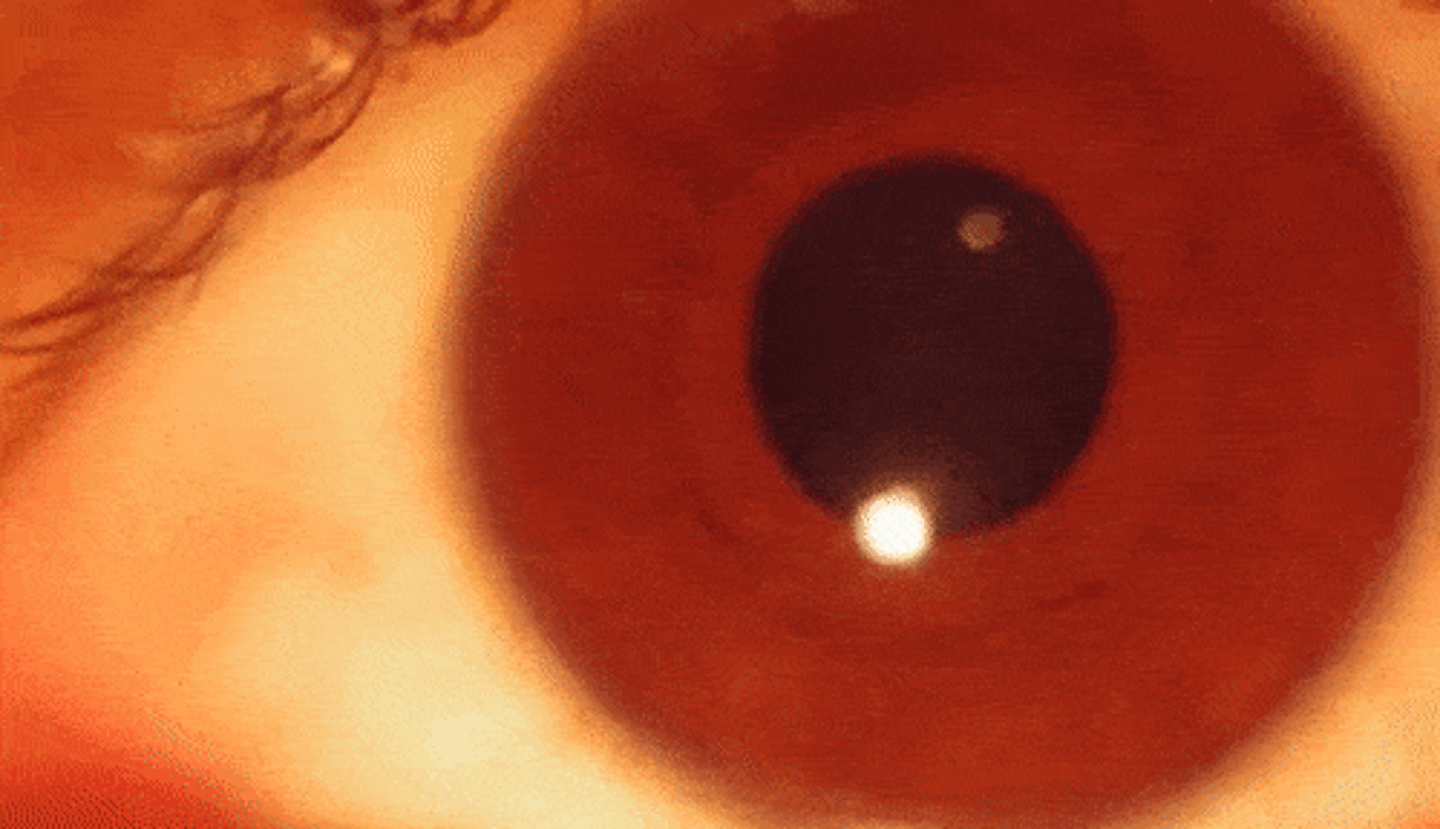 <p>Pupillary hippus</p>