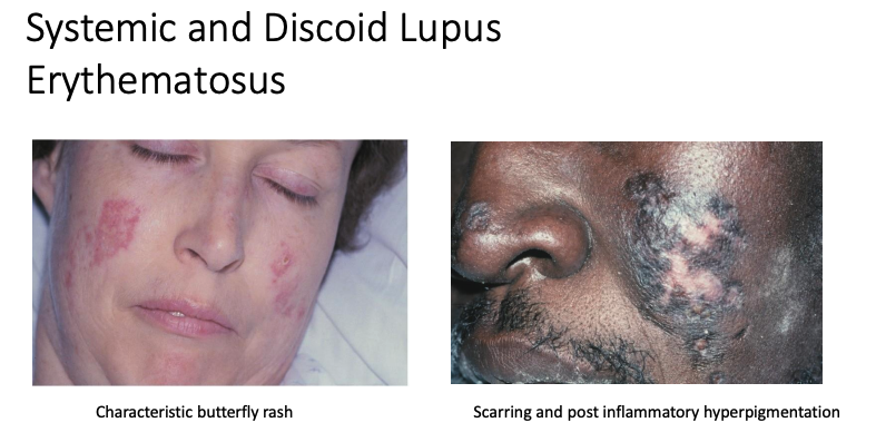 <p>Lupus Erythematosus</p>