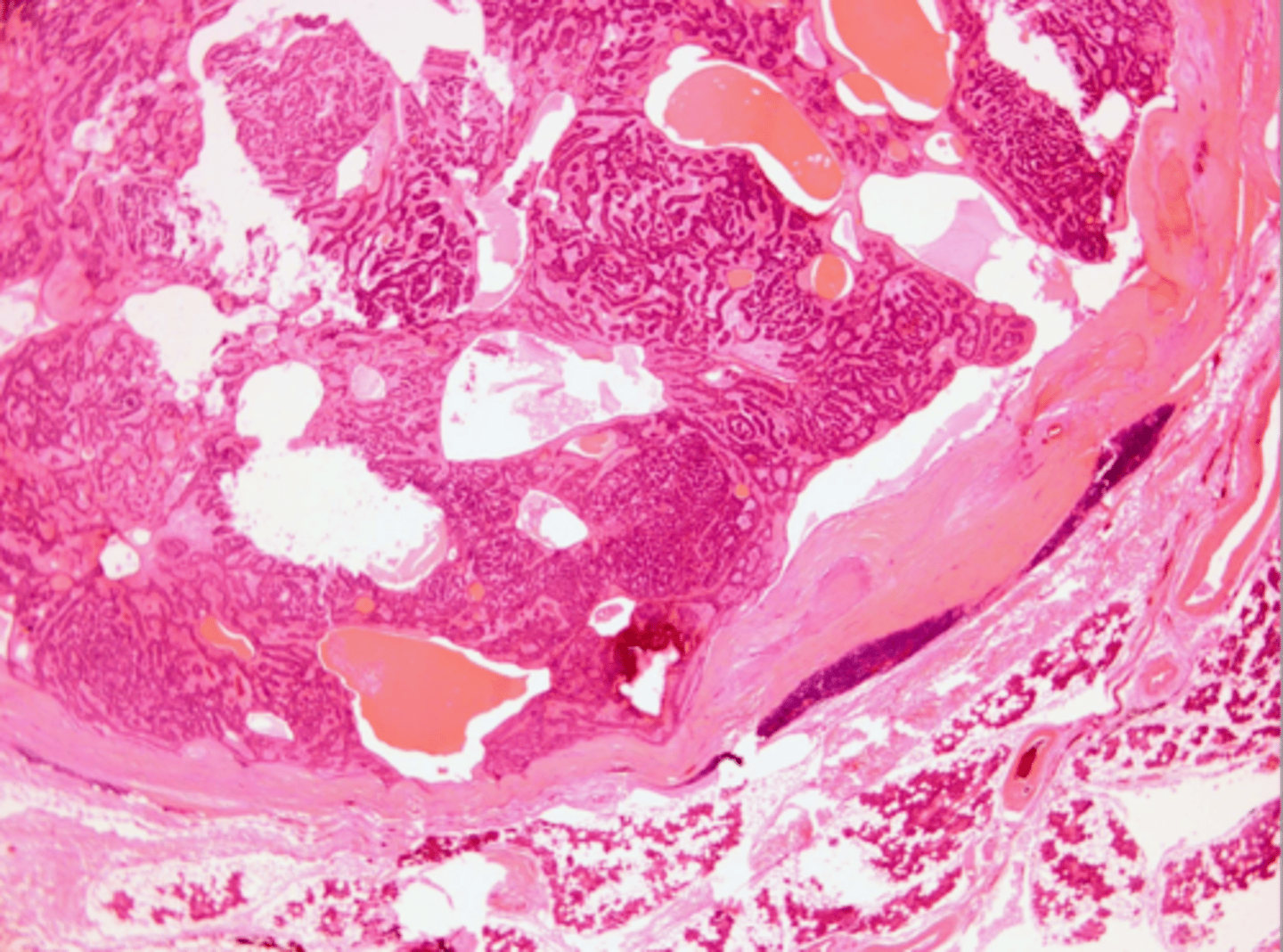 <p>Well encapsulated, Cell are similar in appearance, Look like canals</p>