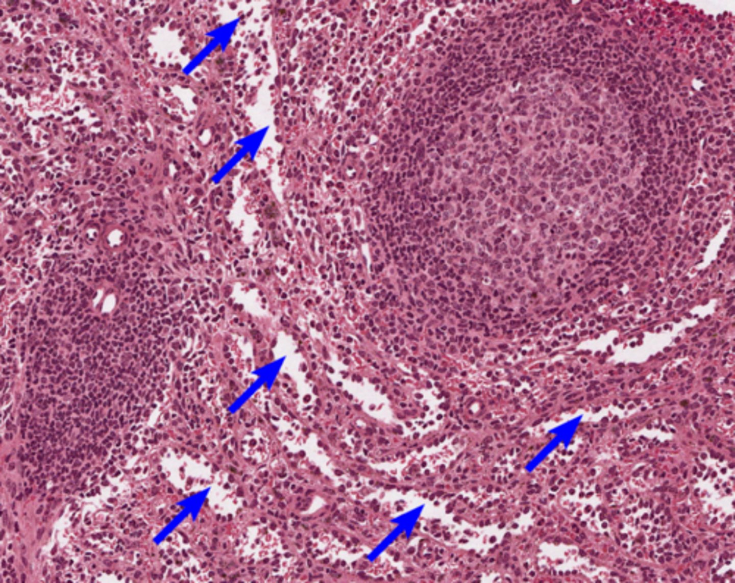 <p>blue arrow in spleen</p>