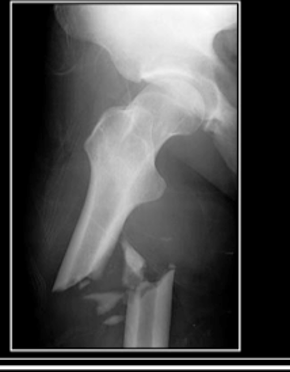 <p>type of fracture where bone breaks into many fragments</p>