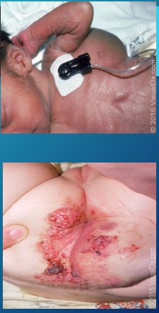 <p><strong>Lymphatic Malformations</strong></p><p>-_______, slow flow vascular lesions composed of dilated __________ channels&nbsp;</p><p>-Macrocystic (cystic hygroma)</p><ul><li><p>Collection of large, interconnected lymphatic ______</p></li><li><p>Present at birth&nbsp;</p></li><li><p>Large, ___________, soft mass covered by normal skin</p></li><li><p>Most commonly located in ____________, _____, or ______ chest wall&nbsp;</p></li><li><p>½ are associated with __________ abnormalities&nbsp;</p></li></ul><p>-Microcystic (lymphangioma circumscriptum)&nbsp;</p><ul><li><p>Cluster of clear, translucent or hemorrhagic vesicles&nbsp;</p></li><li><p>May present at birth or appear within the first few years of life&nbsp;</p></li><li><p>Most commonly located on ________ extremities, trunk, axilla, or ____ cavity&nbsp;</p></li></ul><p>-Treatment → surgical _________ (MC) or percutaneous chemoablation&nbsp;</p><p></p>