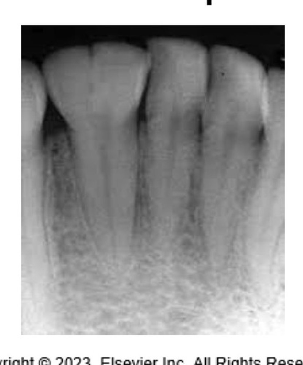 <p>A single tooth germ attempts to divide in 2. Appears as 2 crowns joined together by a notched Incisal area. Radiographically: usually one single root and one common pulp canal. Pt has full complement of teeth.</p>
