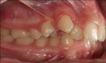 <p>what is the classification of this occlusion?</p>