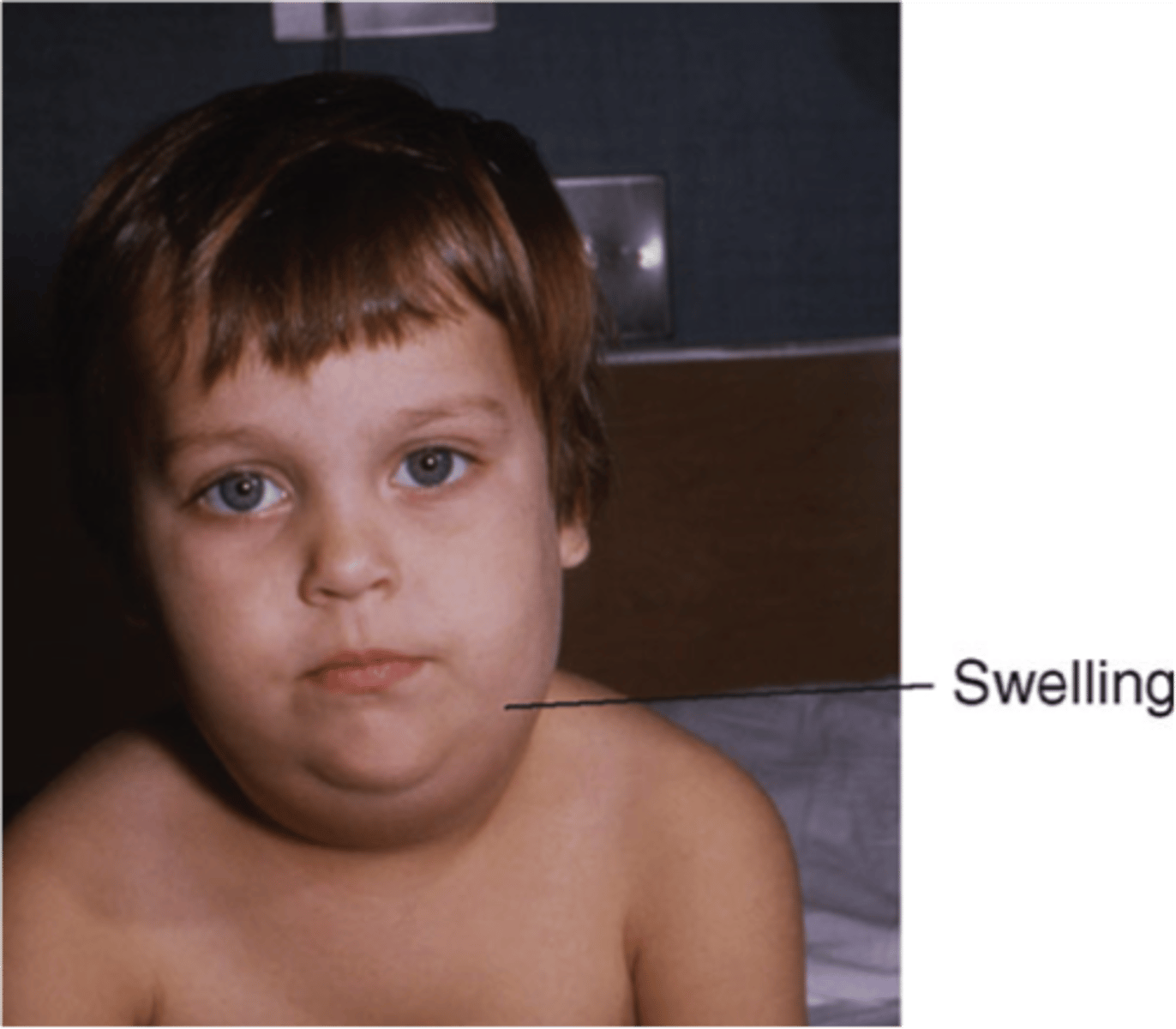 <p>swelling anterior ear</p>