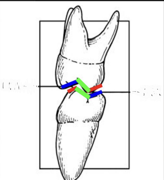 <p>Which of the following line indicates the supporting cusp inner inclines? <strong>exam</strong></p>