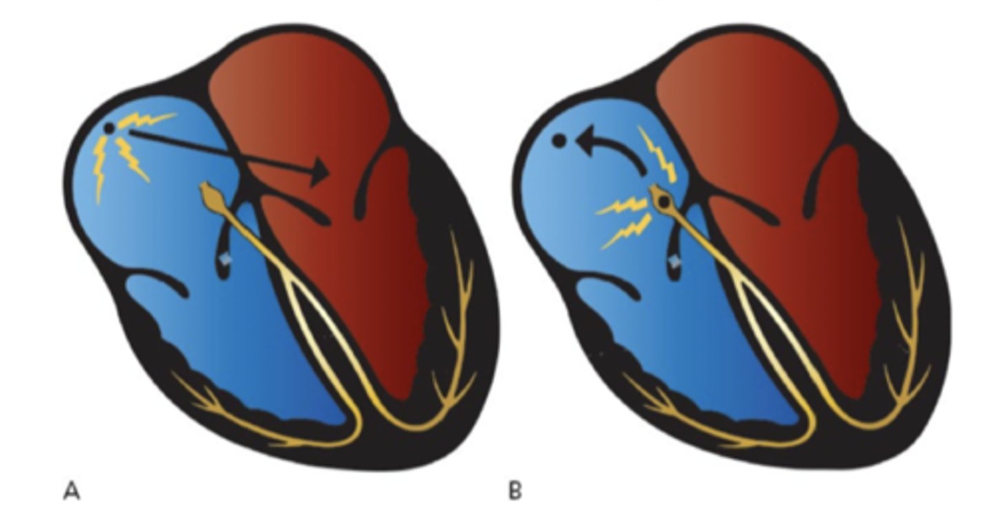 <p>-nonsinus arrhythmias</p><p>-refers to originating outside of sinus node</p><p>-can be a single beat or a sustained beat</p><p>-caused by enhanced automaticity of a non-sinus node pacemaker site</p><p>-disorder or impulse formation</p><p>-digitalis toxicity, caffeine, alcohol, stimulants, and psychological stress</p>