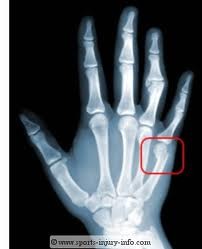 fx of the neck of the 5th MC
results in acute angulation of the head of the MC into palm
mechanism of injury - typically punching a wall, not a seasoned boxer