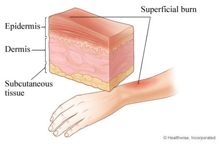 <p>•only the epidermis is damaged</p><p>•Symptoms include localized redness, swelling, and pain</p>