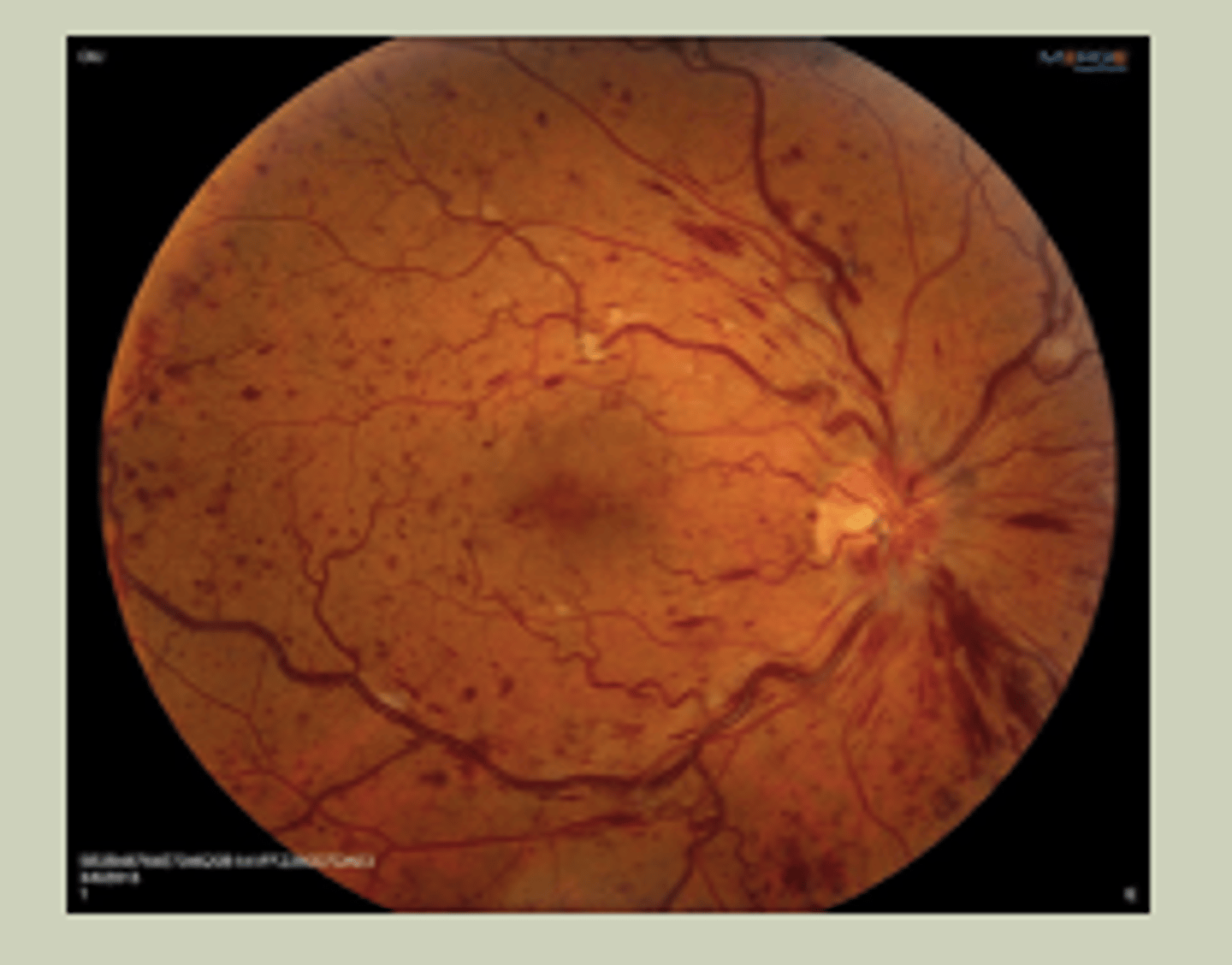 <p>-Sudden, painless blurred vision in one eye</p><p>-Associated with HTN</p><p>-See "Blood and thunder" on DO</p><p>-TX: URGENT referral to ECP STAT referral to retinal specialist</p>