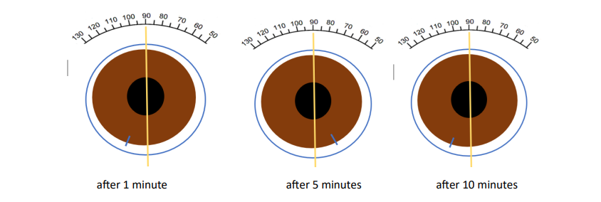 <p>You are assessing the fit of a soft toric contact lens for a patient’s right eye, and you see the following lens appearance. The yellow line is for reference and is your light beam set at 90degrees. The Contact lens prescription for this eye is -1.00/-0.75 x 180 (1 mark)</p><p></p><p> Keep the same prescription -1.00/-0.75 x 180 </p><p> Amend lens prescription to -1.00/-0.75 x 20 </p><p> Amend lens prescription to -1.00/-0.75 x 200 </p><p> Amend lens prescription to -1.00/-0.75 x 160 </p><p> Amend lens type to another toric as unstable prescription</p>